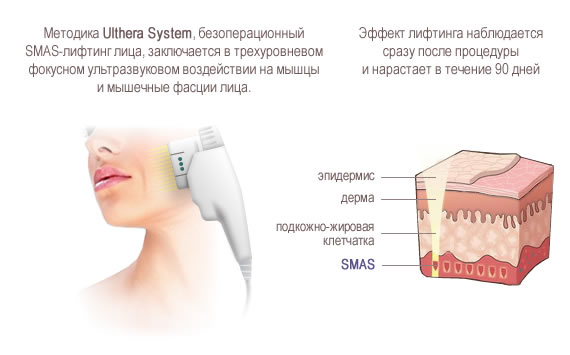 Ультразвуковой SMAS-лифтинг Ulthera System